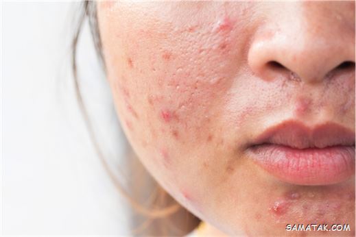 غذاهای جوش اور؛ چه غذاهایی باعث جوش زدن صورت می شود