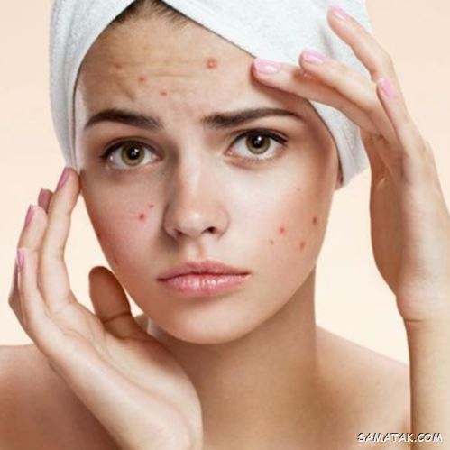 غذاهای جوش اور؛ چه غذاهایی باعث جوش زدن صورت می شود