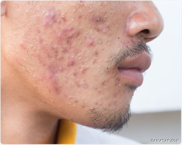 غذاهای جوش اور؛ چه غذاهایی باعث جوش زدن صورت می شود