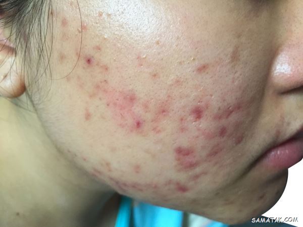 غذاهای جوش اور؛ چه غذاهایی باعث جوش زدن صورت می شود