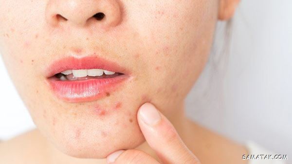 غذاهای جوش اور؛ چه غذاهایی باعث جوش زدن صورت می شود