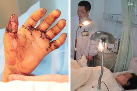 10 انگشت قطع شده دست این کارگر پیوند زده شد (تصاویر 16+) 10 انگشت قطع شده دست این کارگر پیوند زده شد (تصاویر 16+)