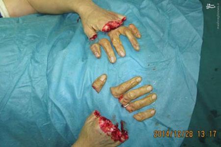 10 انگشت قطع شده دست این کارگر پیوند زده شد (تصاویر 16+) 10 انگشت قطع شده دست این کارگر پیوند زده شد (تصاویر 16+)