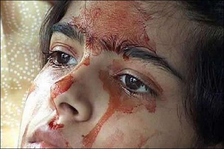 دختری که خون گریه می کند: بیماری عجیب «اشک خونین» چیست؟ 1 دختری که خون گریه می کند