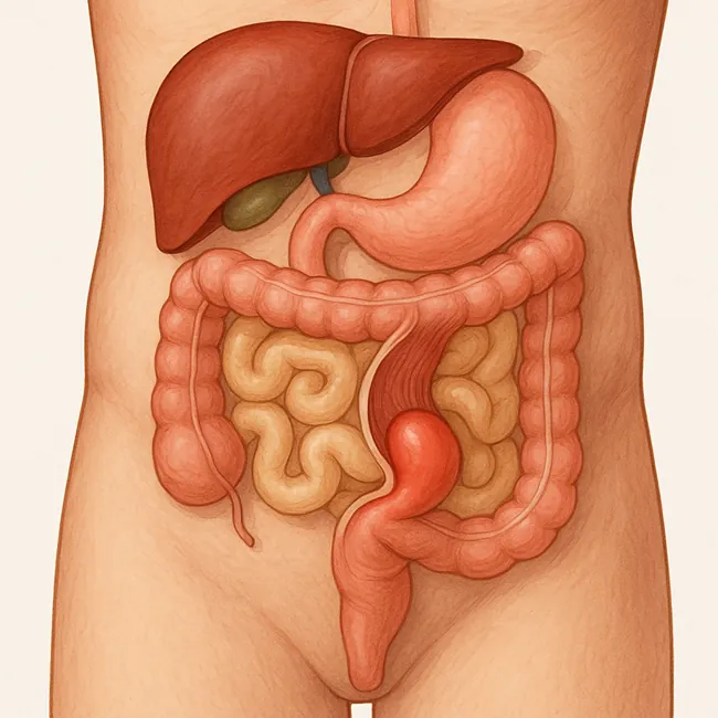 بیماری هرنی یا فتق hernia چیست؟ علائم، علت ها و درمان 3 بیماری هرنی یا فتق hernia چیست 3