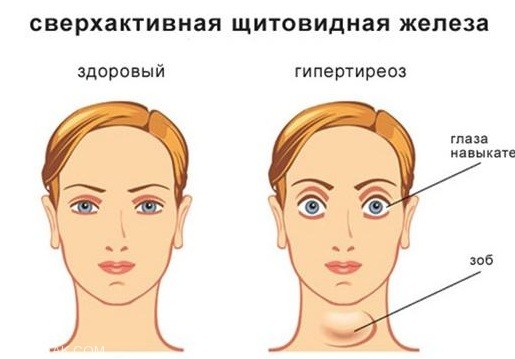 نوع خاصی از بیماری با نرمال نبودن سایز چشم نوع خاصی از بیماری با نرمال نبودن سایز چشم