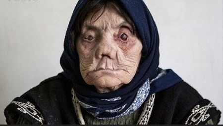 جذام چیست؟ | دانستنی هایی درباره بیماران جذامی جذام چیست؟ | دانستنی هایی درباره بیماران جذامی