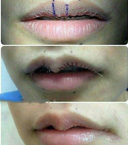 عمل جراحی زیبایی غنچه کردن لب ها + تصاویر عمل جراحی زیبایی غنچه کردن لب ها + تصاویر