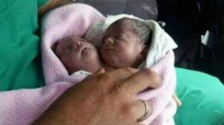 نوزاد وحشتناک دو سر در سوریه به دنیا آمد + تصاویر نوزاد وحشتناک دو سر در سوریه به دنیا آمد + تصاویر