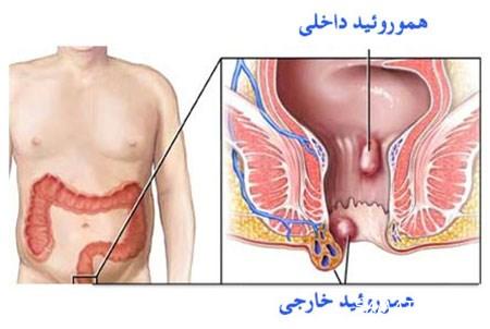 درد مقعدی در مردان درد مقعدی در مردان