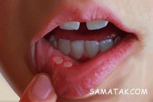 آفت دهان درمان + آفت دهان و ایدز 2 1591821418 samatak com
