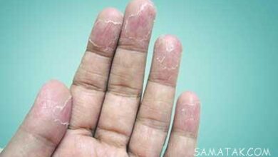 پوست پوست شدن انگشتان دست، کف پا و صورت 18 734364646 samatak com