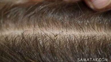 طرز استفاده اسپند برای از بین بردن شپش سر کودکان 1 570674461 samatak com