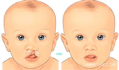 علت لب شکری بودن نوزاد چیست 1 1830256891 samatak com