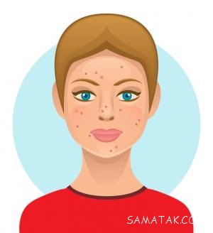 مواد غذایی که باعث جوش صورت میشود 1 807426660 samatak com