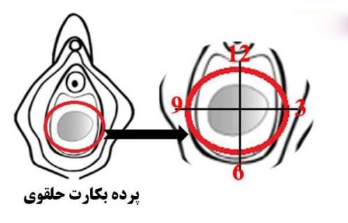 پرده بکارت حلقوی پرده بکارت حلقوی
