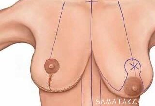 لیفت سینه یعنی چه | انواع روشهای لیفت سینه ها برای زنان 83 63123840 samatak com