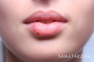 بهترین پماد برای درمان تبخال تناسلی، لب و دهان 7 1012054021 samatak com