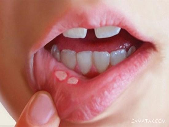 بهترین پماد برای درمان تبخال تناسلی، لب و دهان