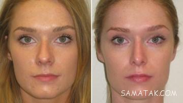 راه های کوچک شدن بینی گوشتی بدون عمل جراحی 164 1336165509 samatak com