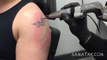 پاك كردن تاتو با ليزر در يك جلسه 3 690886843 samatak com