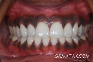 سیاه شدن لثه دندان روکش شده | درمان خانگی سیاه شدن لثه 6 2027339303 samatak com