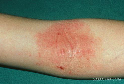 پماد تاکرولیموس برای چیست Tacrolimus | عوارض و موارد استفاده پماد تاکرولیموس پماد تاکرولیموس برای چیست Tacrolimus | عوارض و موارد استفاده پماد تاکرولیموس