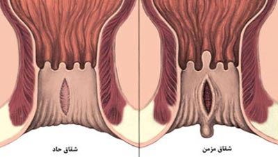 شقاق یا فیشر مقعدی چیست و بهترین و کم هزینه ترین روش درمان