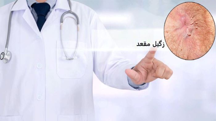 زگیل تناسلی و زگیل مقعد، شایع ترین بیماریهای آمیزشی 1 1730223365 samatak com