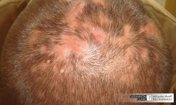 آیا ورم بعد از کاشت مو طبیعی است؟ آیا ورم بعد از کاشت مو طبیعی است؟