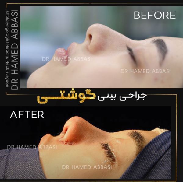 مراحل عمل بینی مراحل عمل بینی