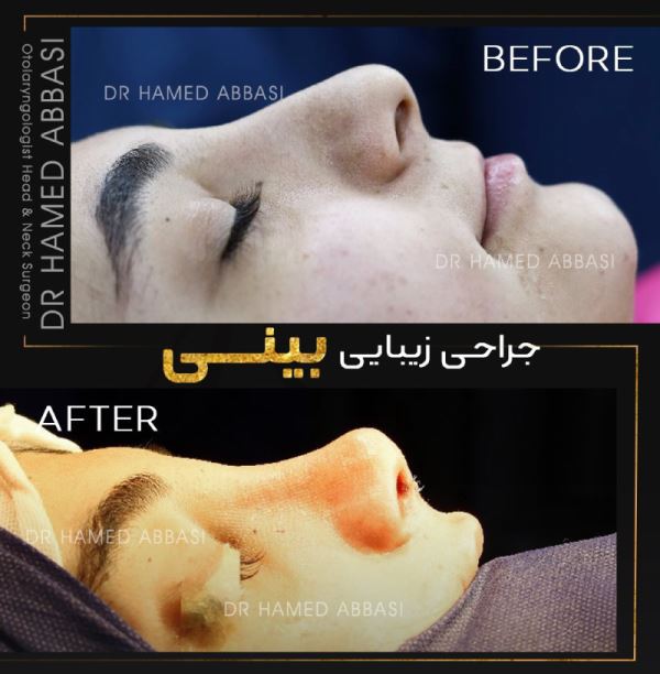 مراحل عمل بینی مراحل عمل بینی