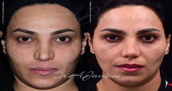 مراحل جراحی بینی مراحل جراحی بینی