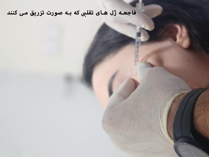فاجعه ژل های تقلبی که به صورت تزریق می کنند! 1 فاجعه ژل های تقلبی 2
