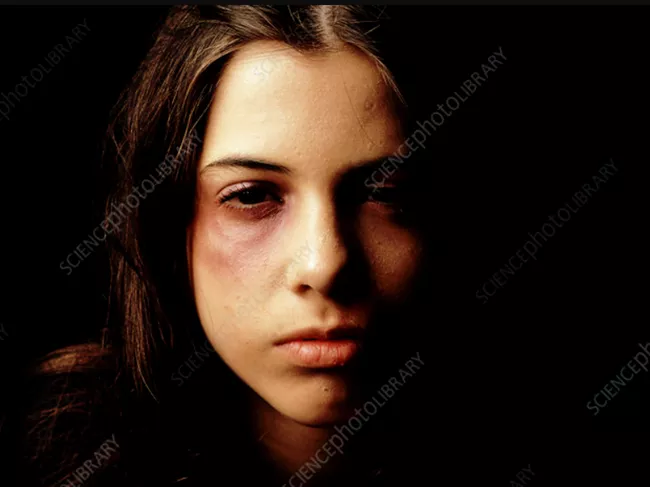 عکس صورت کبود دختر برای پروفایل 4